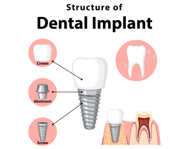 Dental Implants Blue Ash Ohio